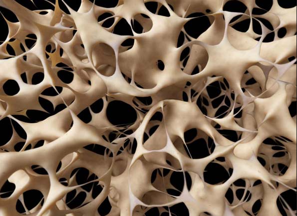 osteoporoza1